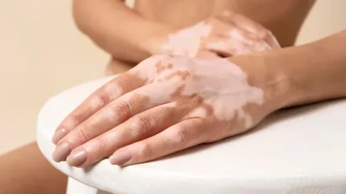 Hari Vitiligo Sedunia 25 Juni: Meningkatkan Kesadaran dan Dukungan bagi Penyintas