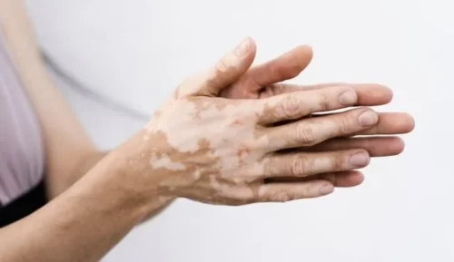 Hari Vitiligo Sedunia: Sejarah, Dampak, dan Harapan bagi Penyintas