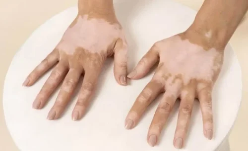 Hari Vitiligo Sedunia: Sejarah, Fakta, dan Upaya Meningkatkan Kesadaran Global