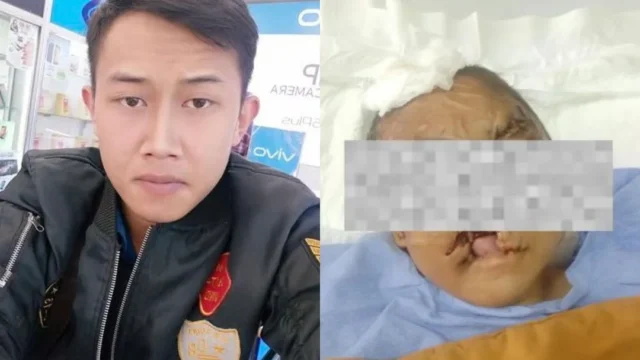 Kondisi Terkini Korban Taufik Hidayat, Mulai Operasi Bibir