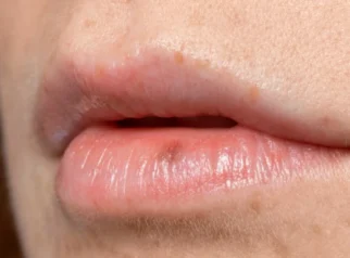Penyebab Jerawat di Area Bibir Mulut