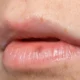 Inilah Penyebab tumbuh Jerawat di Area Bibir Mulut
